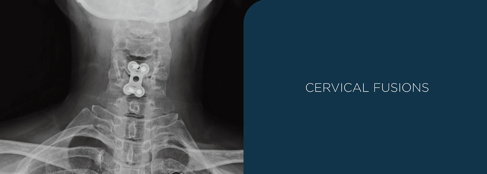 cervical fusions