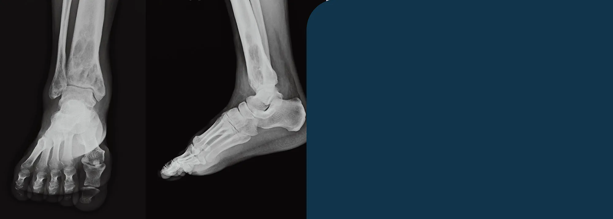 foot ankle x-ray